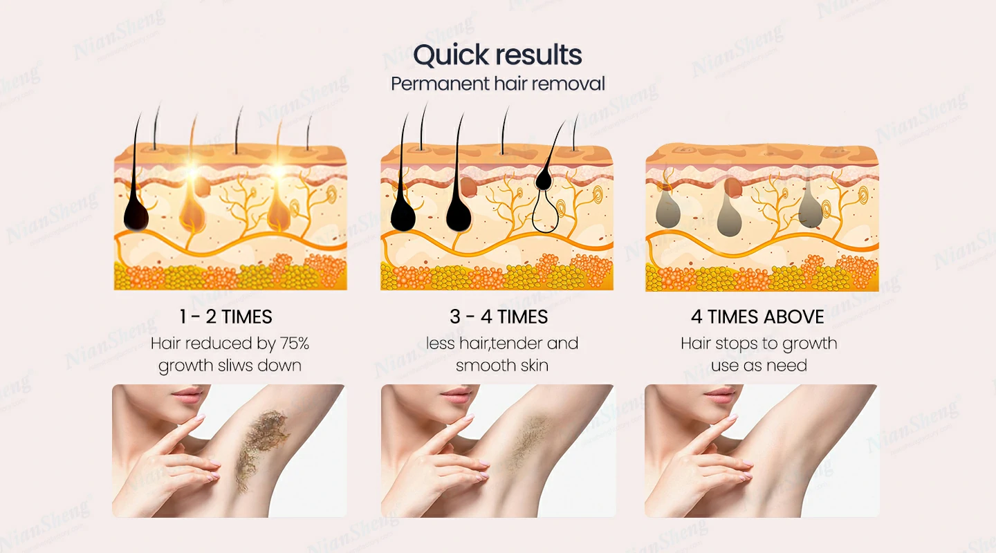 Niansheng Beauty diode laser hair moval machine -y20